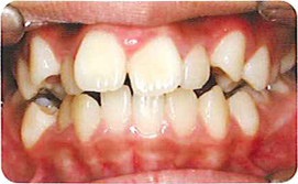 矯正を始める前